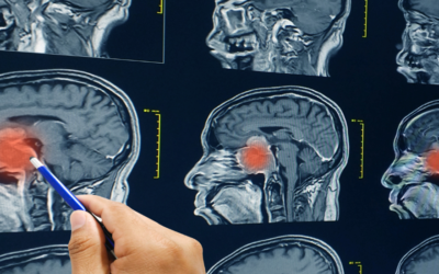 Do I have a brain tumour?